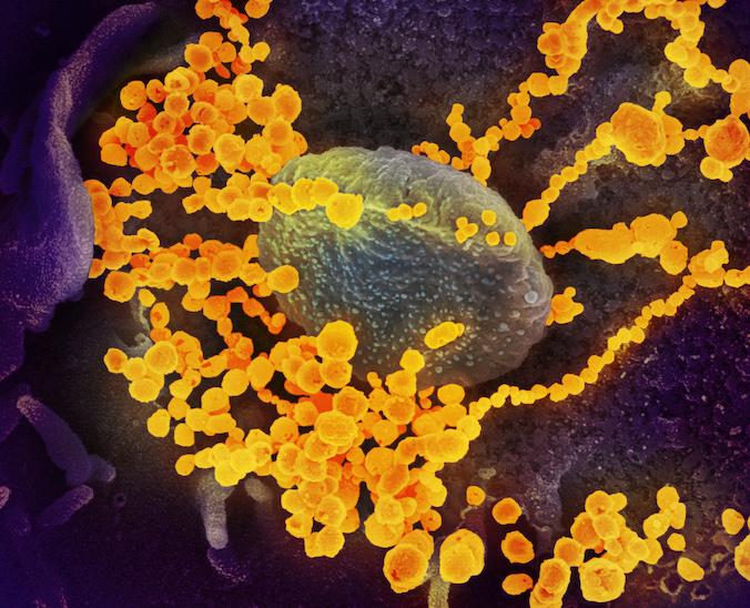 Ten obraz z elektronowego mikroskopu skaningowego pokazuje wirusa KPCh (okrągłe żółte kropki), wyłaniającego się z powierzchni komórek wyhodowanych w laboratorium. Pokazany wirus został wyizolowany od pacjenta z USA. Zdjęcie wykonane i pokolorowane w NIAID Rocky Mountain Laboratories (RML) w Hamilton, Montana (fot. <a href="https://www.flickr.com/photos/niaid/49557785797/in/album-72157712914621487/">NIAID-RML</a>, <a href="https://creativecommons.org/licenses/by/2.0/">CC BY 2.0</a>)