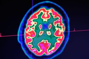 Naukowcy uważają, że być może odkryli przyczynę choroby Alzheimera