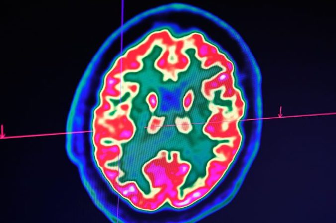 Archiwalne zdjęcie ludzkiego mózgu wykonane za pomocą skanera pozytonowej tomografii emisyjnej, zwanej również skanowaniem PET, wyświetlone na ekranie w Regionalnym i Uniwersyteckim Centrum Szpitalnym w Breście, zachodnia Francja, 9.01.2019 r. (Fred Tanneau/AFP/Getty Images)