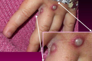 Objawy wirusa ospy małpiej widoczne na dłoni pacjenta, 27.05.2003 r. (CDC / Getty Images)